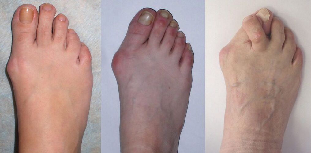 Fußarthritis
