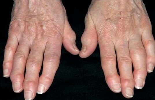 Hand -Arthrose