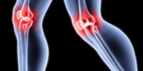 Knie -Arthrose