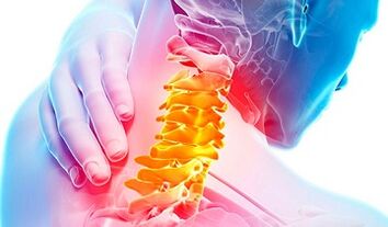 Anzeichen einer Osteochondrose der Halsspalte