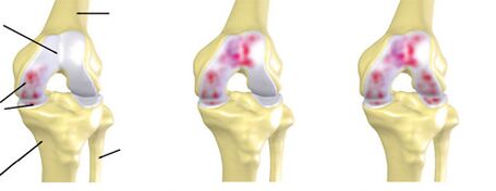 Grad der Arthrose