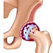 Hüftgelenk -Osteoarthritis