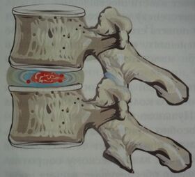 Erstes Stadium der Osteochondrose.