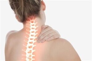 Zervikale Osteochondrose bei einer Frau.